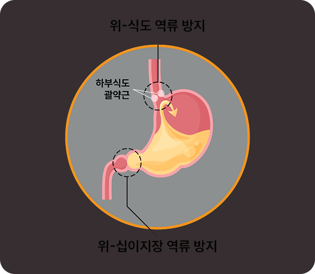 역류성식도염 원인